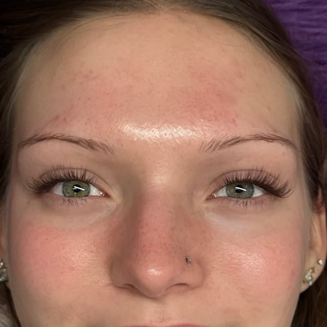 The Essential Fill at Abtsolute Beauty in Sioux Falls, SD